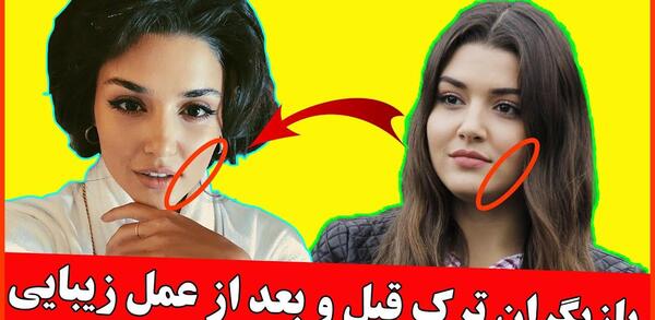عکس قبل عمل هلال آلتینبیلک