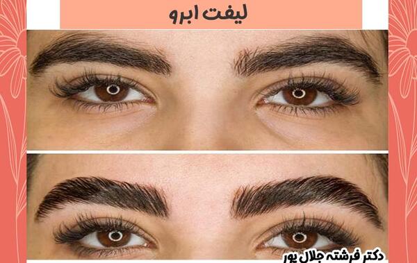 عکس قبل و بعد لیفت ابرو