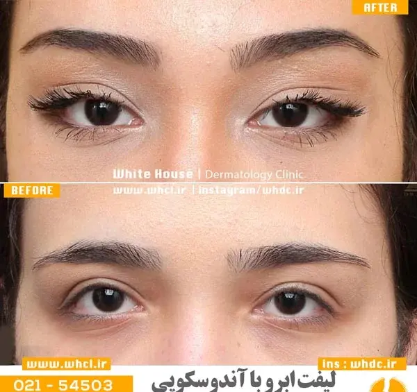 عکس قبل و بعد لیفت ابرو
