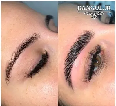 عکس قبل و بعد لیفت ابرو