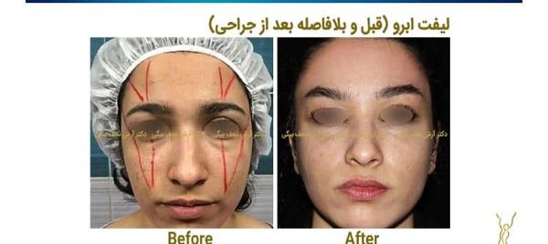 عکس قبل و بعد لیفت ابرو
