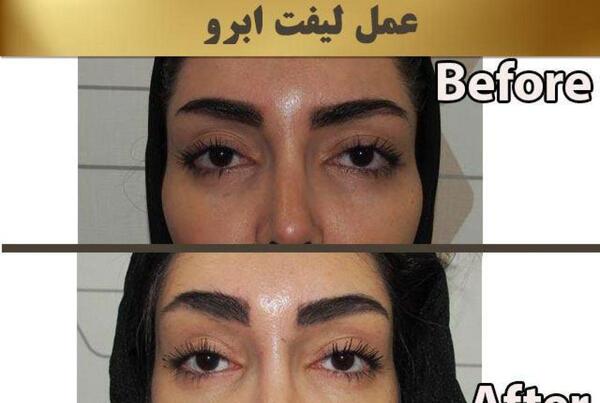 عکس قبل و بعد لیفت ابرو