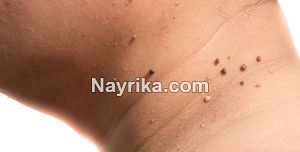 عکس خالهای بدخیم