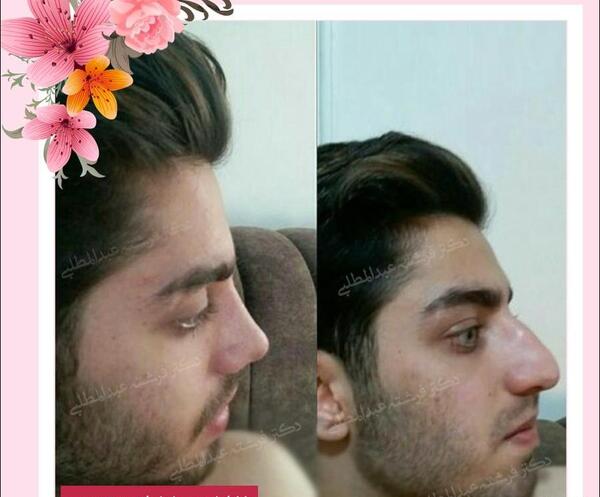 عکس پسر دماغ عملی خوشگل