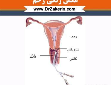 کیا عکس رنگی رحم گرفتن