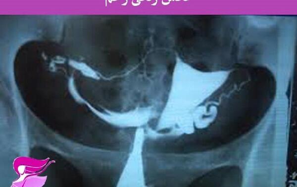 کیا عکس رنگی رحم گرفتن