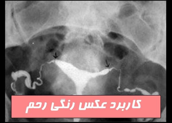 کیا عکس رنگی رحم گرفتن سال ۹۹