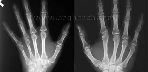 عکس اسکلت دست راست