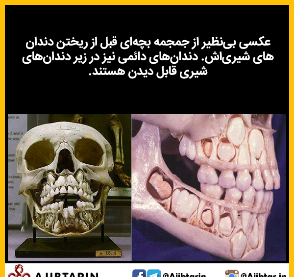عکس اسکلت نوزاد