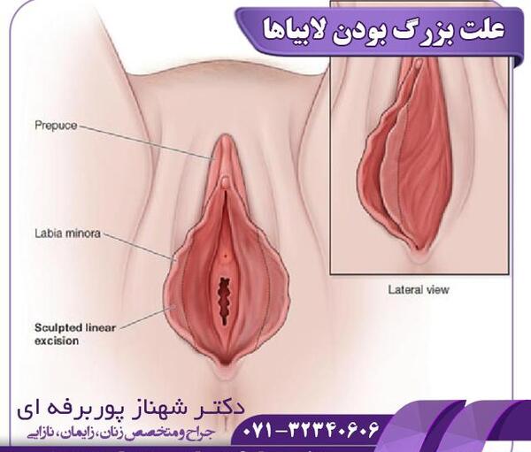 عکس ولوودینیا