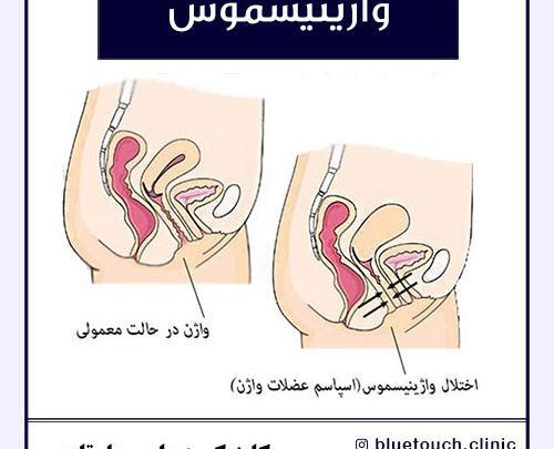 عکس ولوودینیا