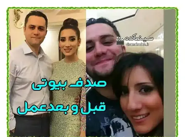 عکس صدف بیوتی قبل از عمل