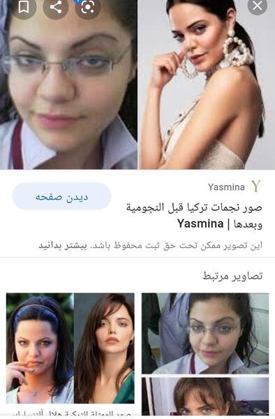عکس ایلول در ضربان قلب قبل از عمل