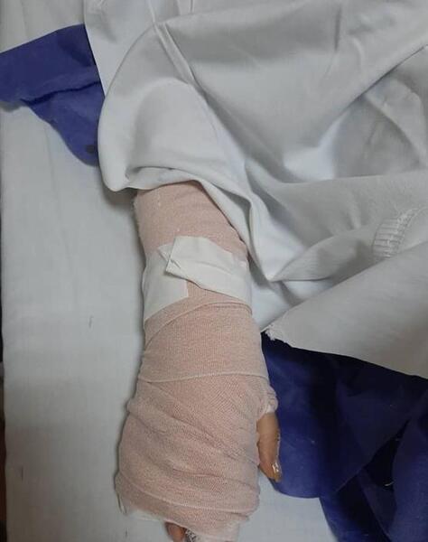 عکس دسته شکسته دختر