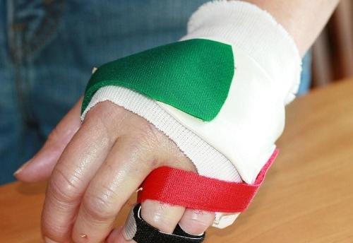 عکس دسته شکسته دختر