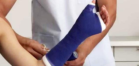 عکس دسته شکسته تو گچ