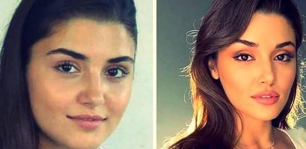 عکس هانده ارچل قبل از عمل زیبایی