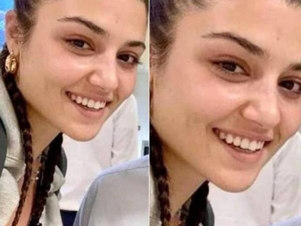 عکس هانده ارچل بعد از عمل زیبایی
