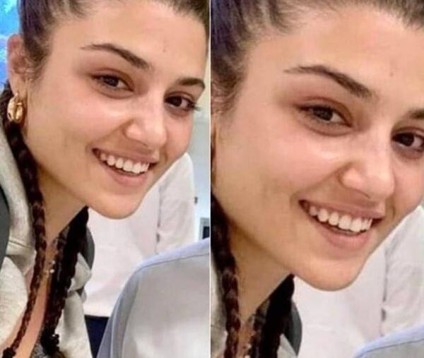 عکس هانده ارچل بدون عمل زیبایی