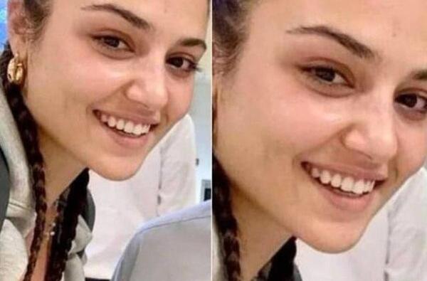 عکس هانده ارچل قبل و بعد عمل