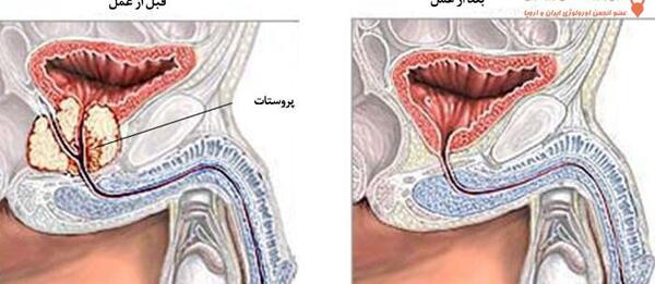 عکس پروستات قبل از عمل