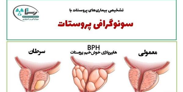 عکس پروستات قبل از عمل