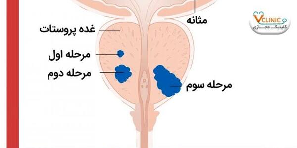 عکس پروستات قبل از عمل