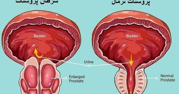 عکس پروستات قبل از عمل