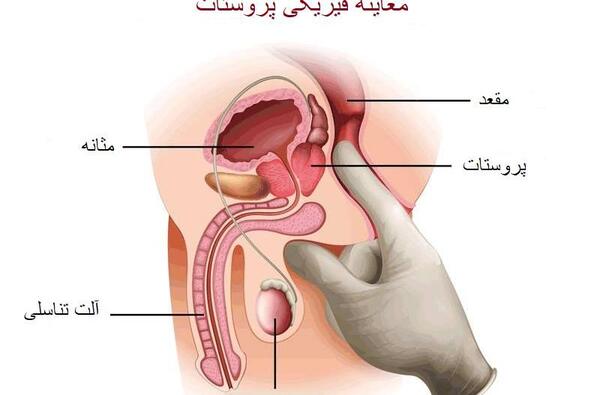 عکس پروستات قبل از عمل
