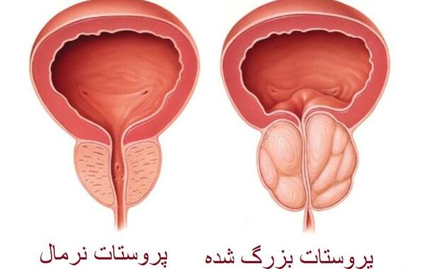 عکس پروستات قبل از عمل