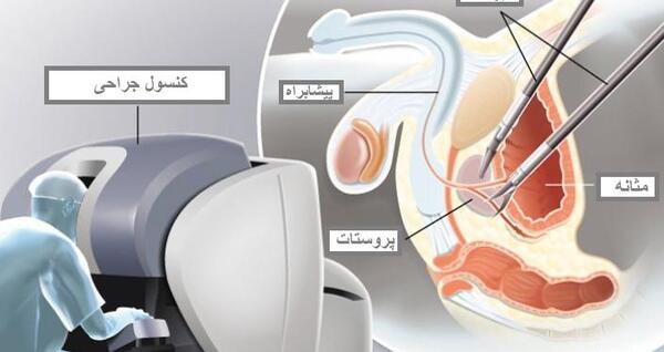 عکس پروستات قبل از عمل