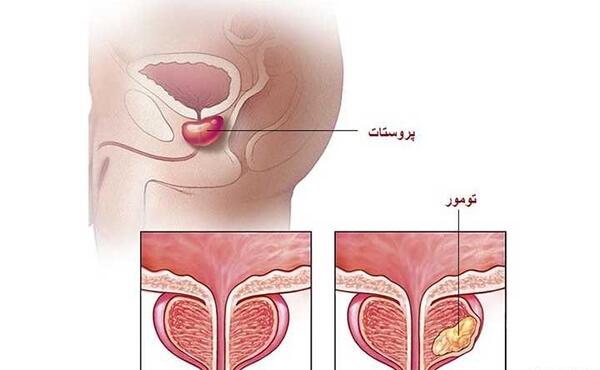 عکس پروستات قبل از عمل