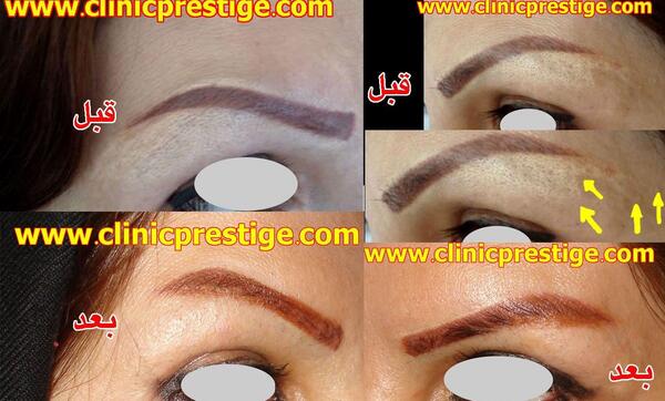 عکس تاتو ابرو قبل و بعد