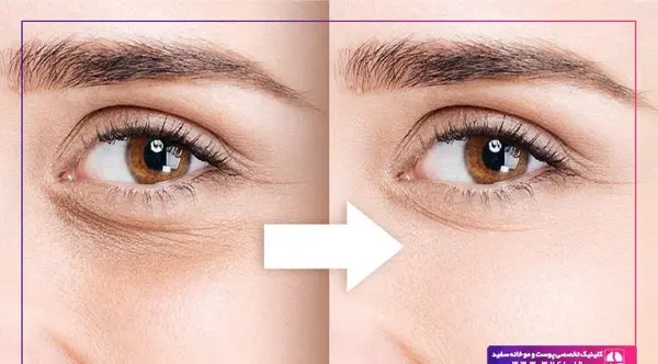 عکس های کبودی چشم