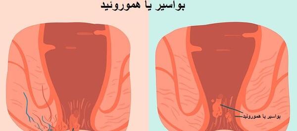 عکس یبوست مردان