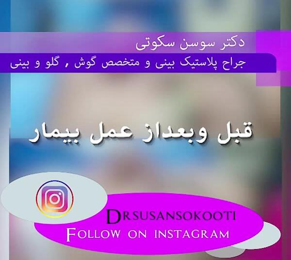 عکس دنیز قبل از عمل