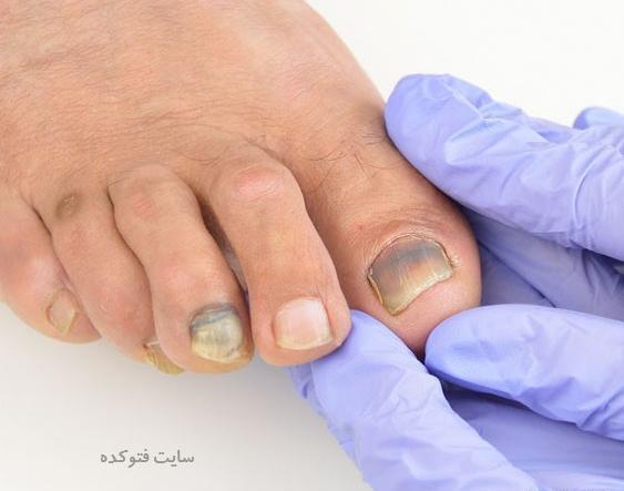 عکس کبودی ناخن پا