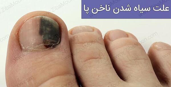 عکس کبودی ناخن پا