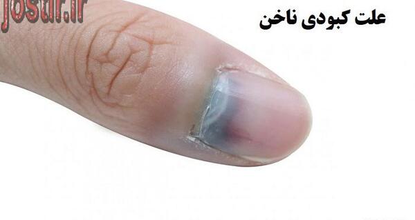عکس کبودی ناخن پا