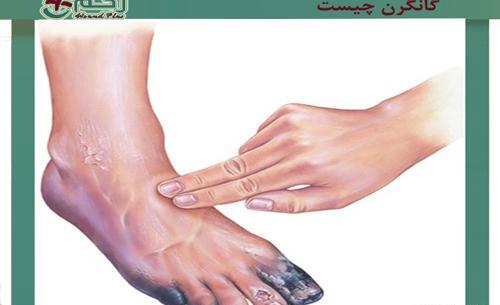 عکس کبودی ناخن پا