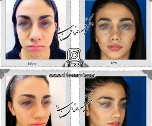 عکس قبل جراحی بینی