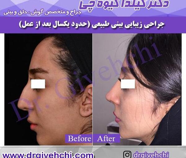 عکس قبل جراحی بینی