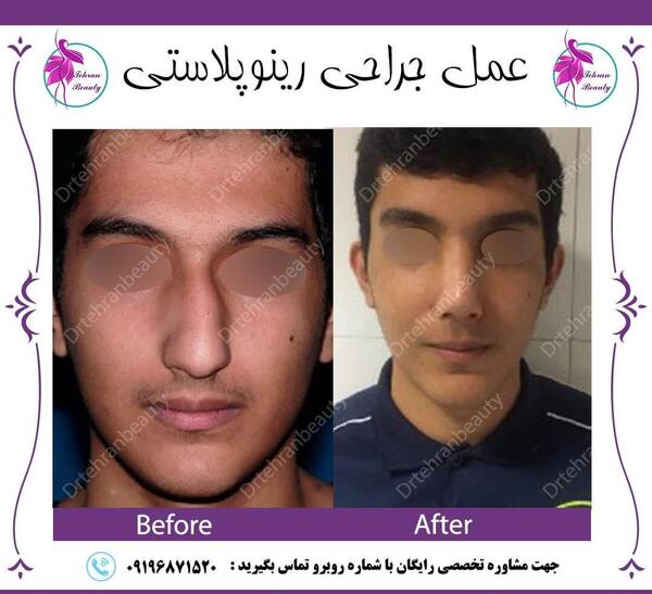 عکس قبل جراحی بینی