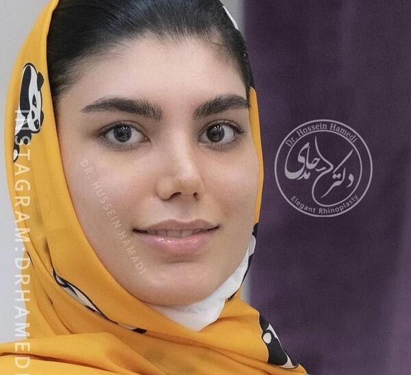 عکس قبل جراحی بینی