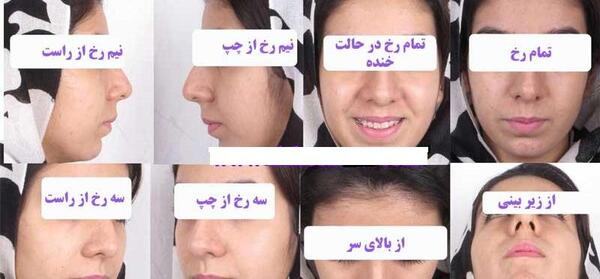 عکس قبل جراحی بینی