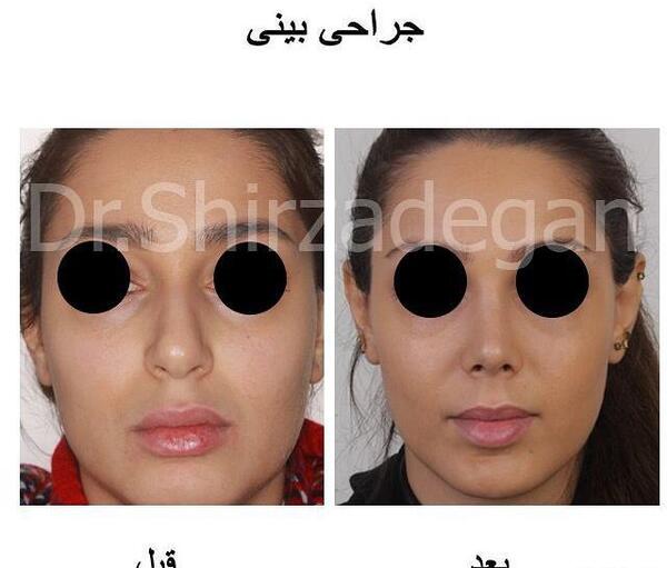 عکس قبل جراحی بینی