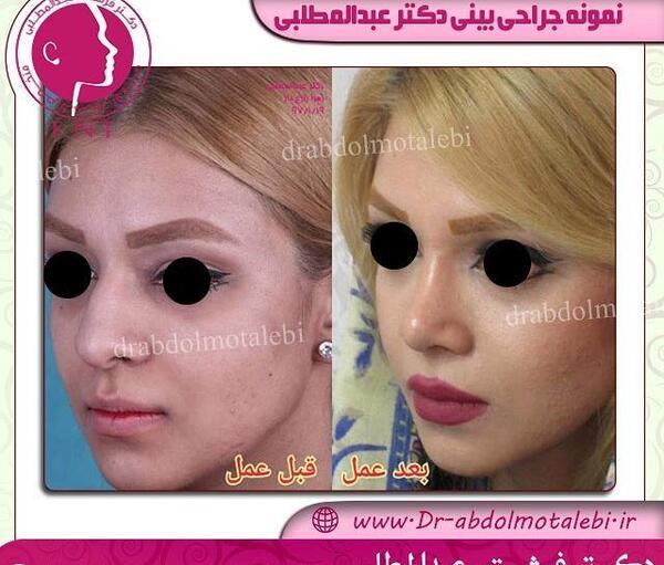 عکس قبل جراحی بینی