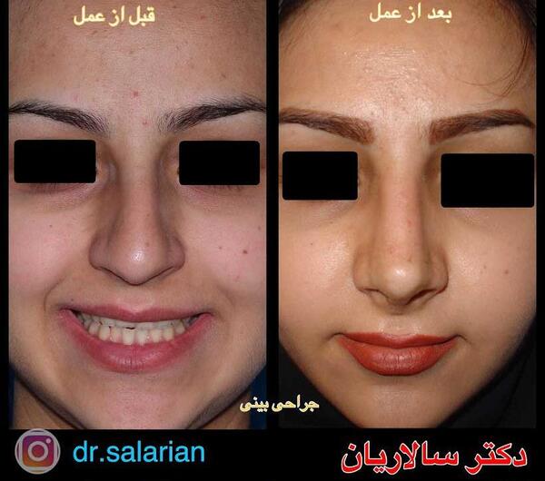 عکس قبل جراحی بینی