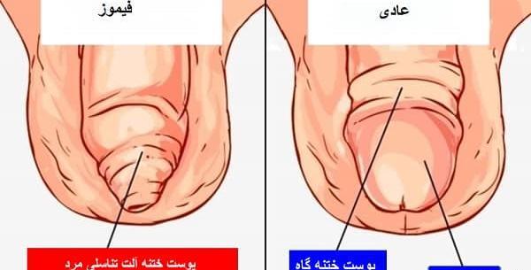 عکس قبل ختنه