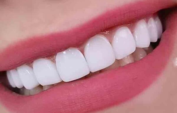 عکس دندانهای سفید